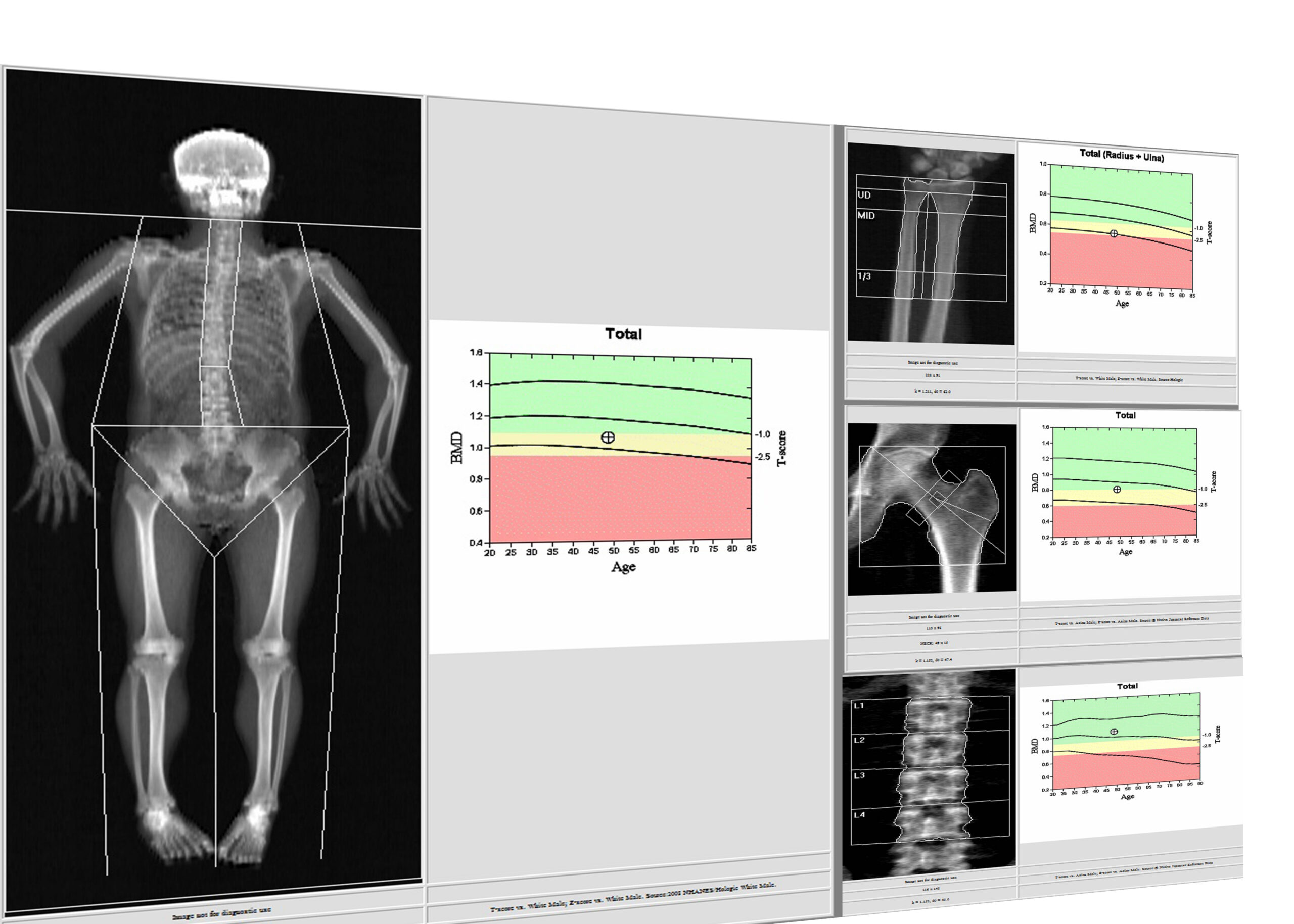 Bone Density Testing at Monument Imaging & Diagnostics Center