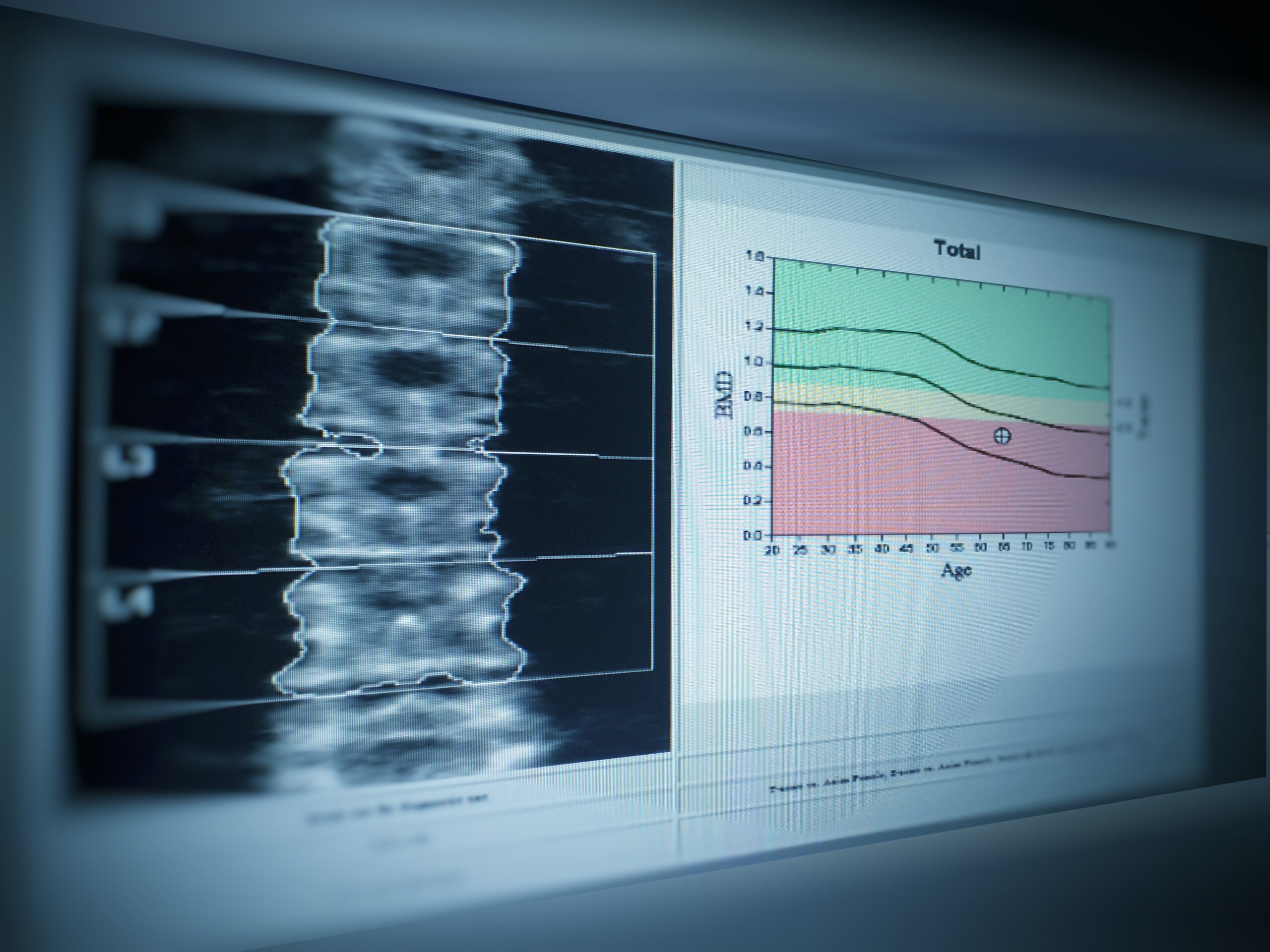 DEXA Scans at Monument Imaging & Diagnostic Center