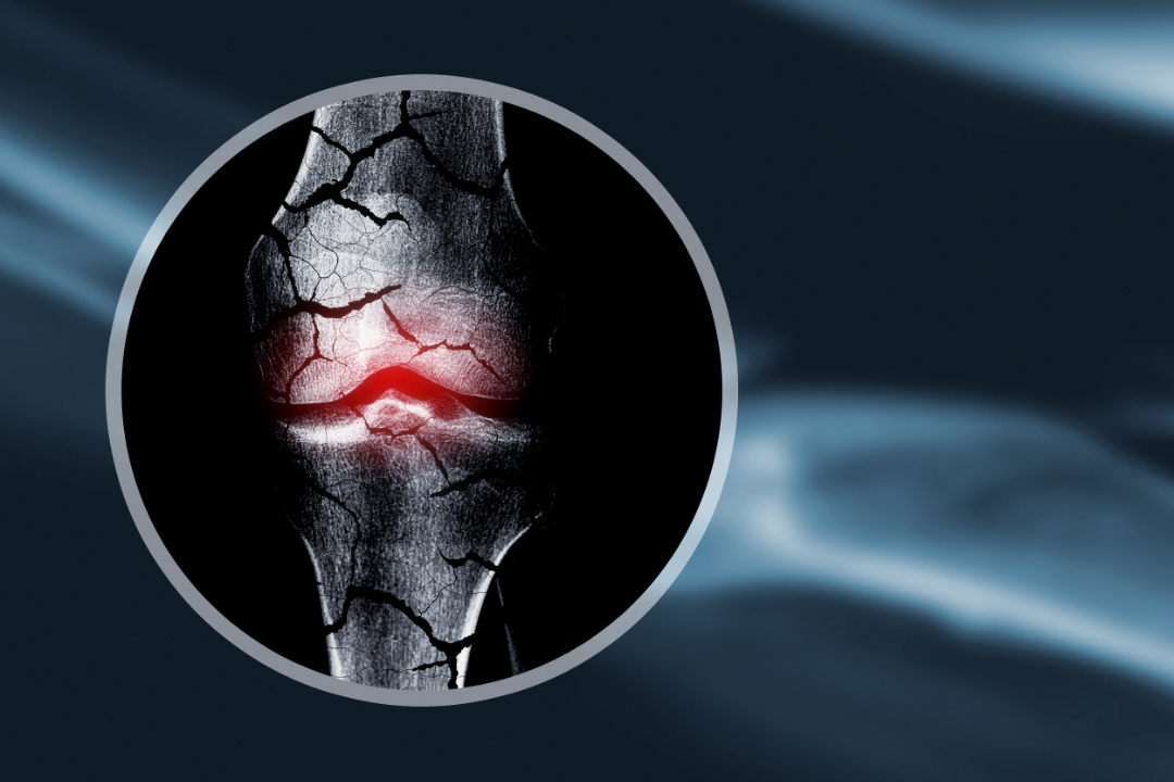 Osteoporosis; DEXA Scan